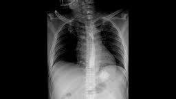 Fluoroscopic footage of a barium swallow test.