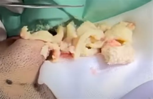 Big Cottage Cheese Cyst Incision and Drainage