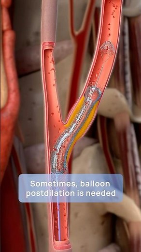 How carotid stenting prevents stroke: a step-by-step 3D guide to restoring blood flow