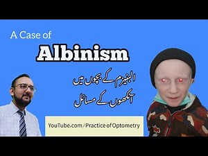 Albino | Albinism | Oculocutaneous Albinism | Why Are Some Children Albino? | Practice Of Optometry