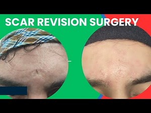 Result of scar revision surgery| Follow up result of scar revision surgery| Best scar treatment