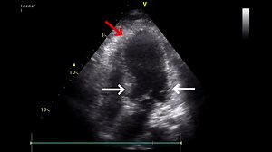 15 reactions | Ultrasound Corner: A 66-Year-Old Woman With Sudden Dyspnea and Shock Read the full research in the May issue to find out the diagnosis: https://hubs.la/Q01QssG60 #MedEd #JournalCHEST | American College of Chest Physicians | Facebook
