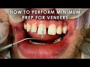 How to perform Minimum Prep for Veneers