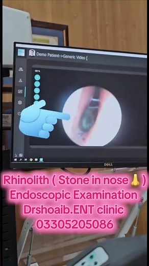 Endoscopic Examination of Rhinolith | Dr Shoaib ENT Clinic