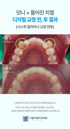 덧니 & 부정교합 환자, 디지털 투명교정으로 교정 #치아교정 #치아교정후기