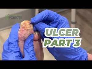 Urgent Ulcer Update | Part 3
