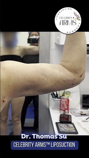 Powerlifter’s Shocking Arm Transformation | 90% Fat Removed with Celebrity Arms™ Liposuction 💪 Tampa