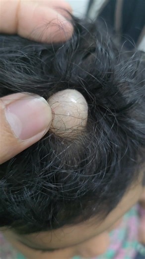 315K views · 1.3K reactions | Scalp cyst horn | Dr Khaled's Tumour Helpline | Facebook