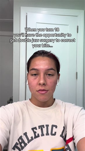 Got it the summer between freshmen and sophomore year of college. The recovery was tough, but it totally changed my life! #doublejawsurgery #jawline #jawsurgery #bracesoff #transformation