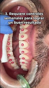 ¿Tienes espacios entre tus dientes? 👀🦷
