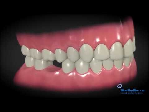 What happens when you are missing a tooth?