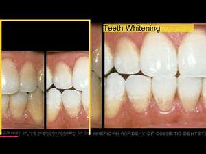 Cosmetic Dentistry: Before and After