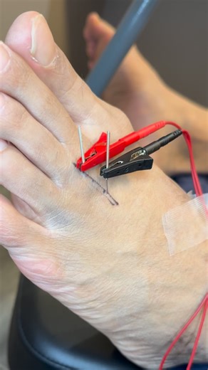 🏆 Dry needling uses a thin needle to target trigger points and release stubborn muscle tension. It’s ideal for chronic pain, nerve irritation, and mobility issues that stretching just won’t fix. Feel the relief and reset your body naturally. #DryNeedling #MuscleRecovery #TriggerPointRelief #ChiropracticCare #SportsPerformance #drkyleross | Dr_kyleross