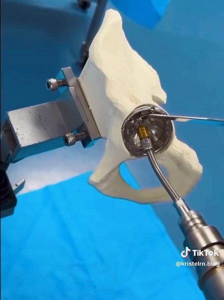 Hip Replacement Procedure Explained by Surgeon