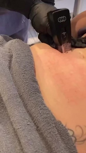 3 comments | Not just a pretty face // Our new InMode Morpheus8...