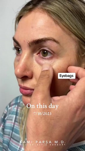 Trifecta Lift and Duplex Treatment for Under Eye Puffiness