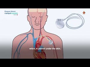 Pacemaker Treatment Explained | Dr. Rohit Kumar, Cardiologist