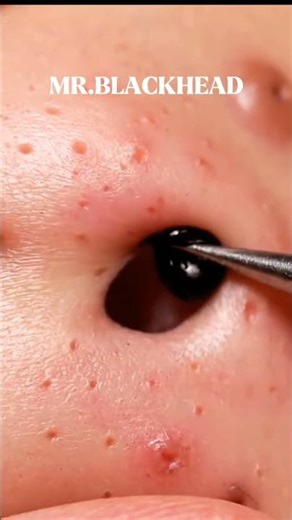 Deep Cystic Blackhead Extractions | Extreme ASMR #shorts