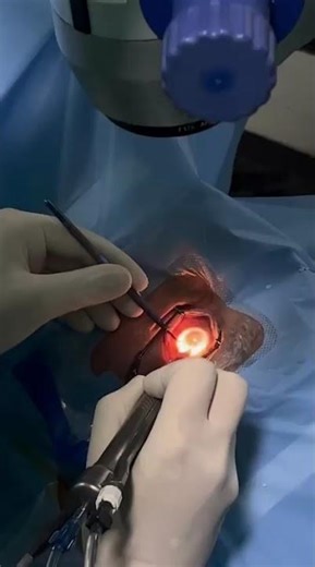 How is a cataract surgery performed?