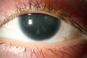 Aniridia: for professionals - Gene Vision