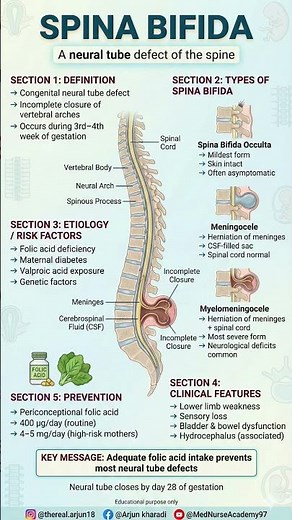 Spina bifida explained simply for nursing & medical exams #NeuralTubeDefect #Nursing