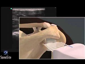 Démo 3D : échographie de l'articulation gléno-humérale - Échographe SonoSite