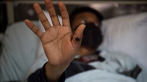 New lethal Mpox strain 'likely already' in UK and could spread in weeks