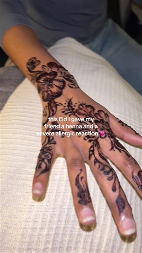 Patch Test For Henna: Avoid Severe Allergic Reactions