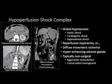 Small Bowell Ischemia