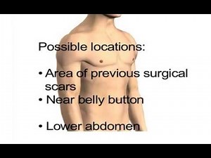 Abdominal Hernia 1- Definition and symptoms