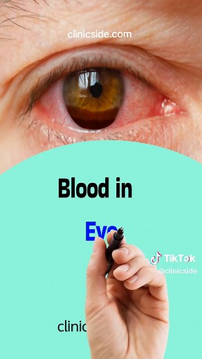 Understanding Medical Terms: Blood in Urine, Stool, Vomit, Sputum, and Semen