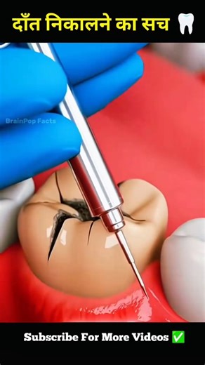 BrainPop Facts | 3D Biology Animation on Instagram: "दाँत कैसे निकाला जाता है? 😬 #ToothExtraction #DentalCare #Dentist #OralHealth #HealthFacts #ScienceBased #Reels #Shorts #Viral #healthtipshindi"
