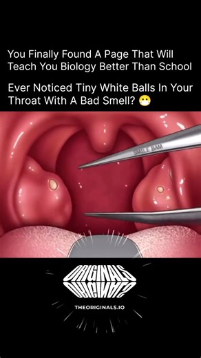 BIOLOGY | MEDICAL | HEALTH on Instagram: "Tonsil stones, also known as tonsilloliths, are small hard formations that develop when food particles, mucus, and dead cells get trapped in the tiny crevices of your tonsils. Over time, this buildup hardens, forming white or yellowish lumps that can cause bad breath and discomfort. Maintaining good oral hygiene, staying hydrated, and cleaning your tongue regularly can help prevent them. In some cases, medical removal may be necessary if they persist or 