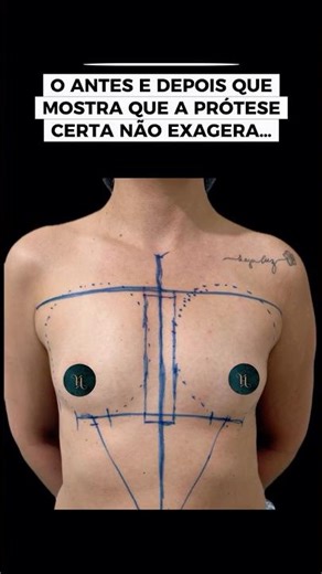 Mamoplastia de aumento #drrenatohallak #cirurgiaplastica