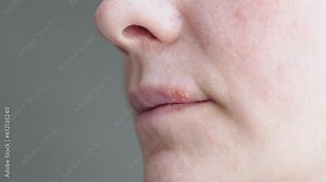 herpes sore on lips vesicles small bumps pimples blisters on upper lip female face. cold and flu sores. white and yellow red translucent bumps filled with clear liquid close-up. dermatology health
