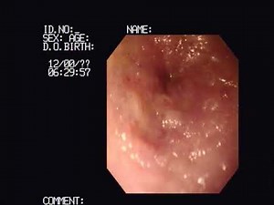 Video 2. Collection of duodenal biopsy samples via endoscopy