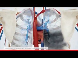 What is a pulmonary embolism?