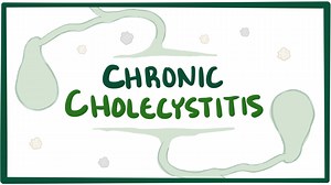 Chronic cholecystitis: Video, Causes, & Meaning | Osmosis