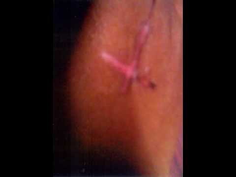 Stigmata -the five wounds of Jesus Christ in living person at Tamil Nadu, India