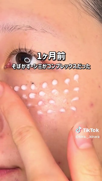 ハイドロキノンの効果と使用結果をレビュー