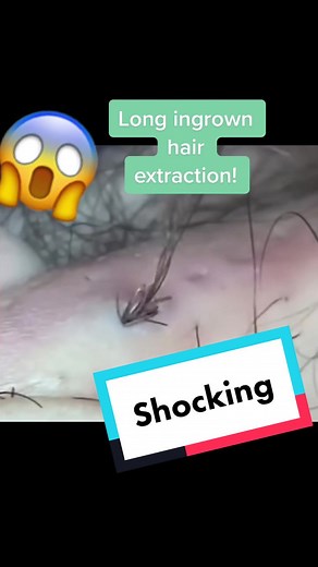 Extremely long ingrown hair extraction. #ingrownhair #ingrownhairextraction #ingrownhairremoval #skincare #acne #blackhead #ingrownhairtok #pimples