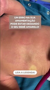 Um ERRO na amamentação pode estar deixando o seu bebê amarelo! LEIA A LEGENDA!