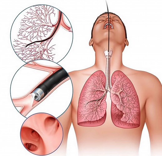Bronchoalveolar lavage procedure, indications, results & complications