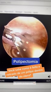Como é feita a polipectomia por vídeo histeroscopia?