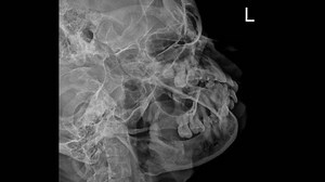 Oblique X-ray Imaging Mandible Comprehensive Analysis Stock Footage Video (100% Royalty-free) 3567675141 | Shutterstock