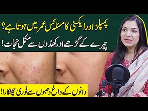 At What Age Do Pimples and Acne Start? Complete Skin Care Guide | Health Matters