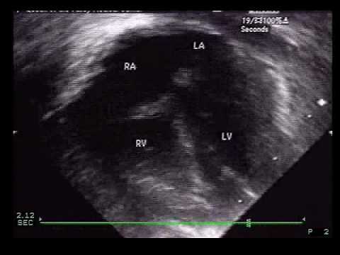 Anomalous Pulmonary Venous Return-Partial