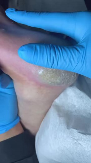 This toenail was hiding something terrifying EZZ2 Beautiful moments of care and relaxation through a gentle pedicure experience. Simple, clean, and satisfying. 🌿✨ Disclaimer: This video is for educational and relaxation purposes only. All content belongs to the respective owners, no copyright infringement is intended. | Care ASMR