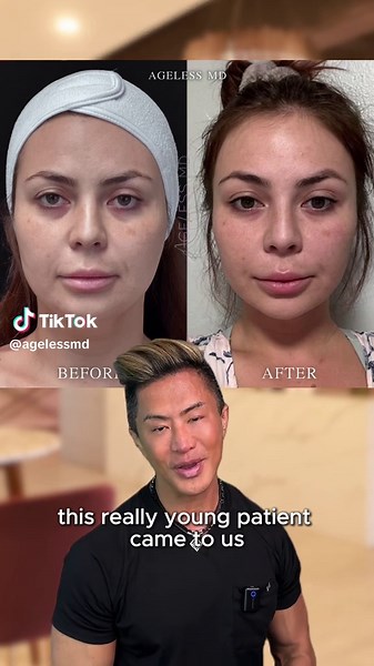 Transforming Double Chin and Neck Skin with Endolift