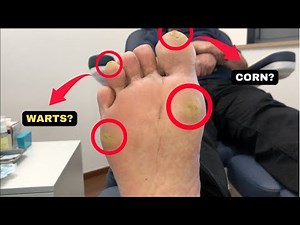 MULTIPLE LARGE CALLUSES AND CORN REMOVAL!
